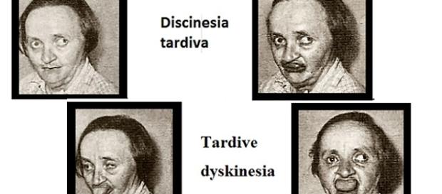 Finalmente arrivano i primi farmaci per controllare questo disturbo di origine iatrogeno. Finalmente arrivano i primi farmaci per controllare questo disturbo di origine iatrogeno.