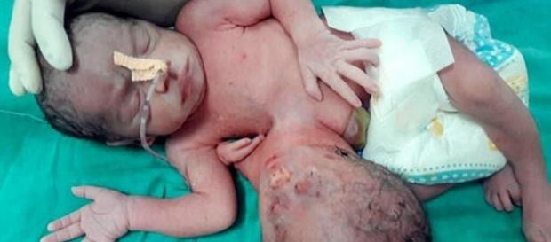 Bebê nasce com um gêmeo parasita Bebê nasce com um gêmeo parasita