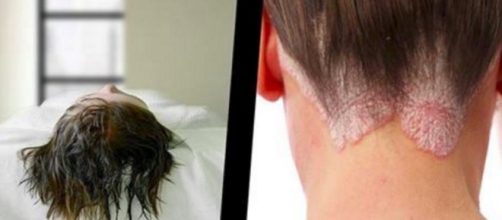 Doenças causadas por dormir com os cabelos molhados