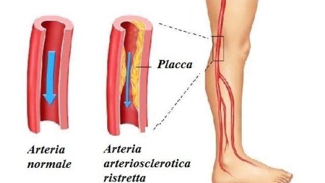 Mangiare frutta e verdura tutti i giorni migliora la circolazione del sangue nelle arterie della gamba riducendo il rischio del PAD.