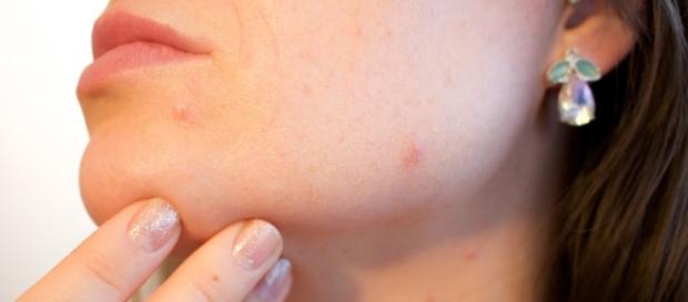 Acne / Photo sourced via CCO Public Domain Pixabay.com Acne / Photo sourced via CCO Public Domain Pixabay.com