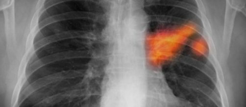 Tumore al polmone: nuova speranza per i non operabili.