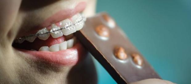Cinco situações que só quem usa aparelho dentário vai entender Cinco situações que só quem usa aparelho dentário vai entender