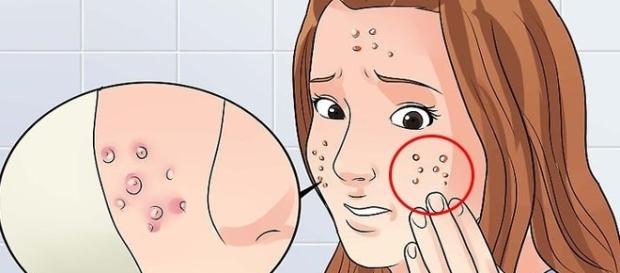 Apesar de incômodo, a acne é uma reação natural do nosso corpo Apesar de incômodo, a acne é uma reação natural do nosso corpo