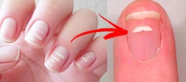 Fique atento às manchas brancas nas unhas Fique atento às manchas brancas nas unhas