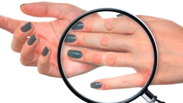 L'alimentazione corretta migliora i sintomi della psoriasi.