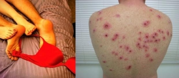Sífilis está de volta com grande impacto, agora na versão Epidemia Sífilis está de volta com grande impacto, agora na versão Epidemia