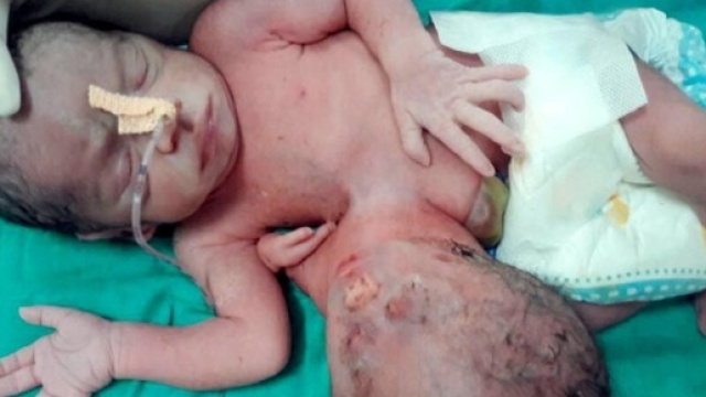 India, bimba con una seconda testa sul petto