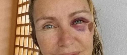 Licia Colò, l'occhio nero: "Sono scivolata sullo skateboard di mia figlia"