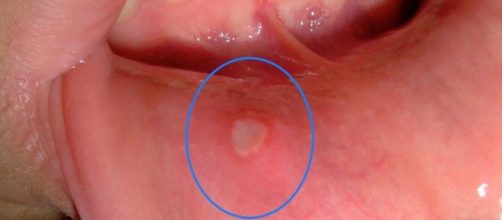 Se você encontrar um ponto branco como este em sua boca, você deve agir rápido. Estes 5 remédios caseiros podem fazer maravilhas.