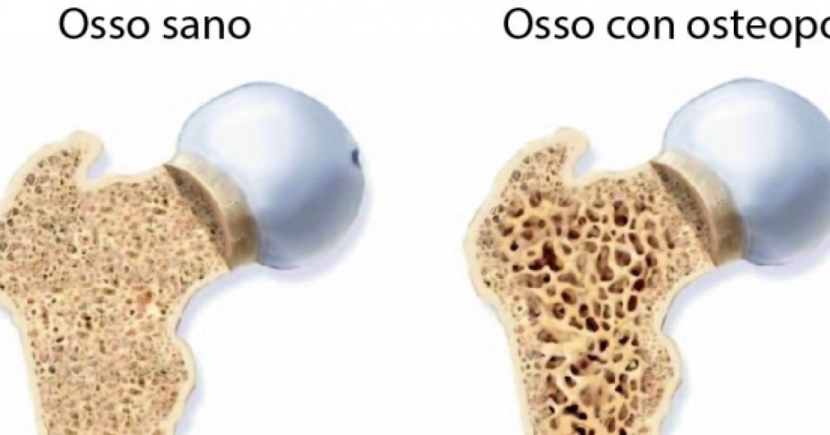 Osteoporosi Scoperta La Cura Della Malattia Rendere Le Ossa Trasparenti