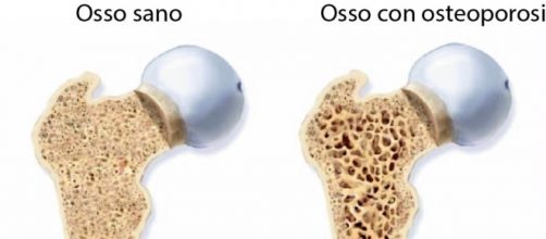 L'osteoporosi , una grave malattia dell'osso.