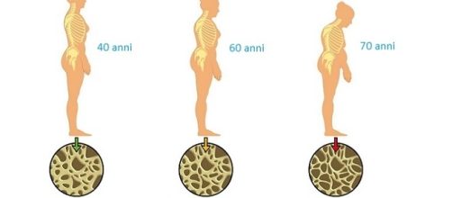 Un nuovo farmaco (abaloparatide) è stato approvato negli Stati Uniti. È indicato nei casi più gravi di osteoporosi.