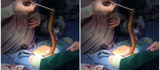 Homem passar por cirurgia para retirada de peixe Homem passar por cirurgia para retirada de peixe