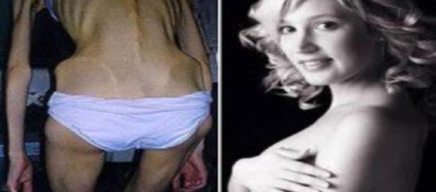 Confira os casos mais extremos de anorexia Confira os casos mais extremos de anorexia