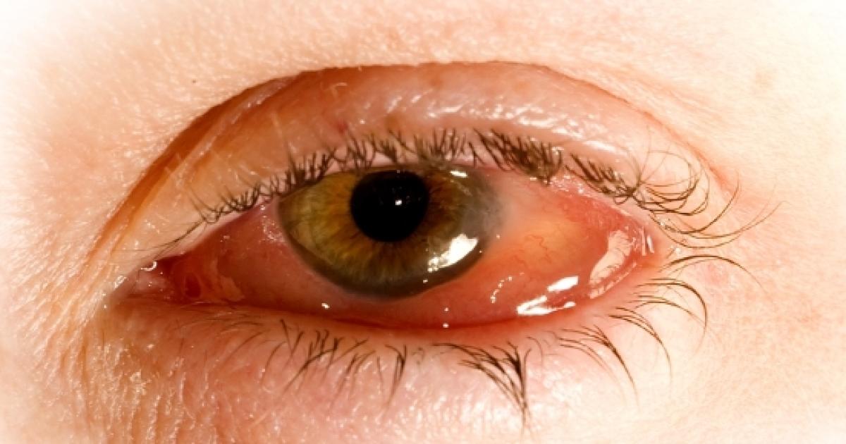 how-to-get-rid-of-conjunctivitis-at-home