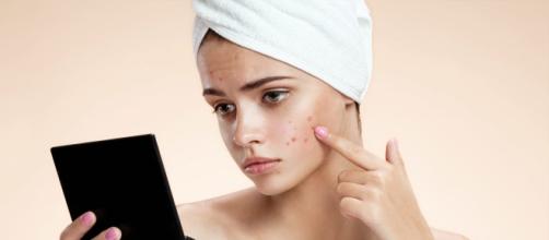 How To Get Rid Of Pimples (Acne) Overnight Fast - stylecraze.com
