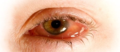 Pink Eye: What it is & How to Treat it Naturally - rebuildyourvision.com