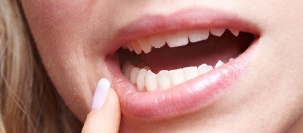 Simple Home Remedies To Treat Mucocele | Great Life and more… - greatlifeandmore.com Simple Home Remedies To Treat Mucocele | Great Life and more… - greatlifeandmore.com