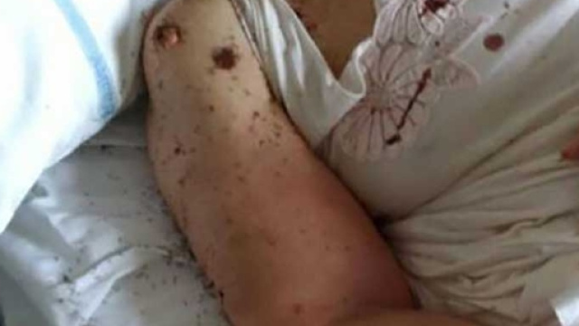 Napoli, formiche sul letto della paziente: malasanit&agrave; al San Paolo