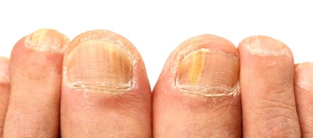 Natural Home Remedies for Removing Yellow Nails - Go Fit ... - gofitstayfit.com Natural Home Remedies for Removing Yellow Nails - Go Fit ... - gofitstayfit.com