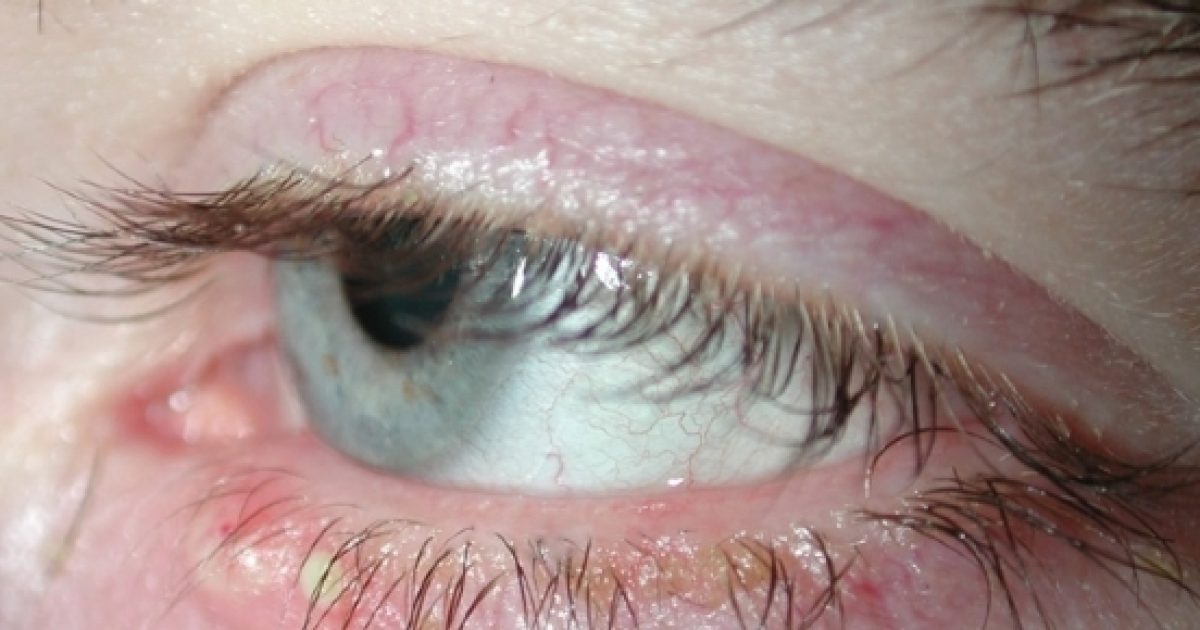 How to treat Blepharitis at home?