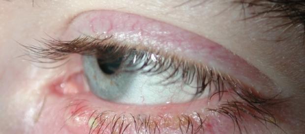Amazing Home Remedies For Blepharitis | Photo via Esther Max, Flickr Amazing Home Remedies For Blepharitis | Photo via Esther Max, Flickr