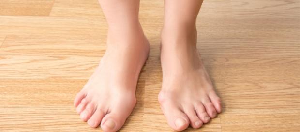 How To Treat Bunions Naturally Without Surgery - Guillaume Paumier via wikimedia How To Treat Bunions Naturally Without Surgery - Guillaume Paumier via wikimedia