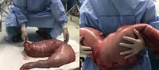 O paciente sofria de uma condição conhecida como Doença de Hirschsprung (DH), que causa constipação severa. O paciente sofria de uma condição conhecida como Doença de Hirschsprung (DH), que causa constipação severa.