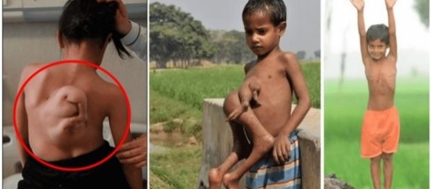Pessoas que nasceram com partes extras no corpo Pessoas que nasceram com partes extras no corpo