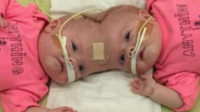 Am Kopf zusammengewachsen: Siamesische Zwillinge erfolgreich ... - hna.de