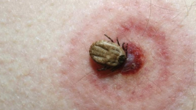 Zecche, &egrave; allerta in Veneto: impennata di malattia di Lyme - vvox.it