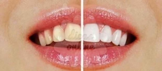 Veja o que deve evitar para escurecer os dentes. (Foto: Reprodução) Veja o que deve evitar para escurecer os dentes. (Foto: Reprodução)
