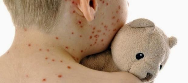 Morbillo, epidemia choc: 6 morti, 'sono quasi tutti bambini' - leggo.it Morbillo, epidemia choc: 6 morti, 'sono quasi tutti bambini' - leggo.it