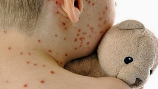 Morbillo, epidemia choc: 6 morti, 'sono quasi tutti bambini' - leggo.it