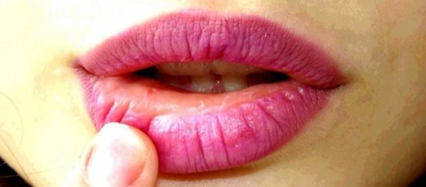 El herpes está causado por un virus, por lo que los antibióticos no tienen ningún efecto sobre él El herpes está causado por un virus, por lo que los antibióticos no tienen ningún efecto sobre él
