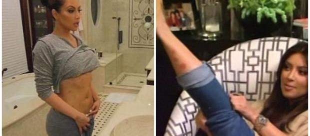 KIm Kardashian tem psoríase, que causa manchas e irritação na pele KIm Kardashian tem psoríase, que causa manchas e irritação na pele