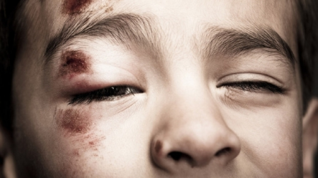 Violenza su bambino disabile di due anni, l'infermiera filmata dai genitori.