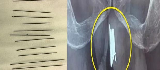 Homem tem 15 agulhas retirada do órgão genital Homem tem 15 agulhas retirada do órgão genital