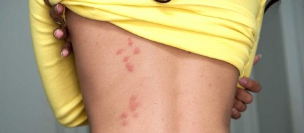Manchas no corpo causadas por estresse Manchas no corpo causadas por estresse