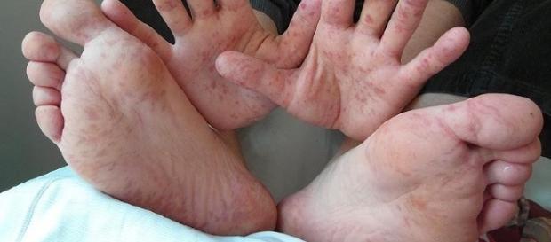 Virus manos-pie-boca, afecta también a los padres. Virus manos-pie-boca, afecta también a los padres.