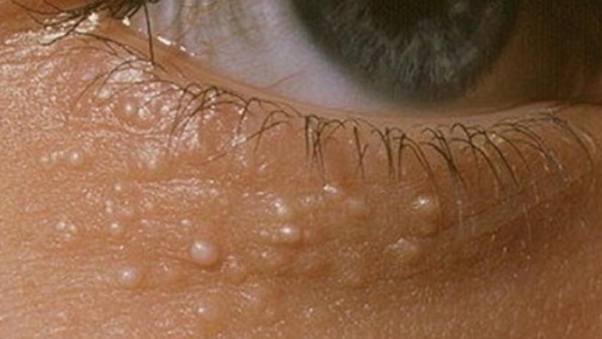 Voce Tem Estes Carocinhos No Rosto Saiba O Que Deve Fazer Voce Tem Estes Carocinhos No Rosto Saiba O Que Deve Fazer