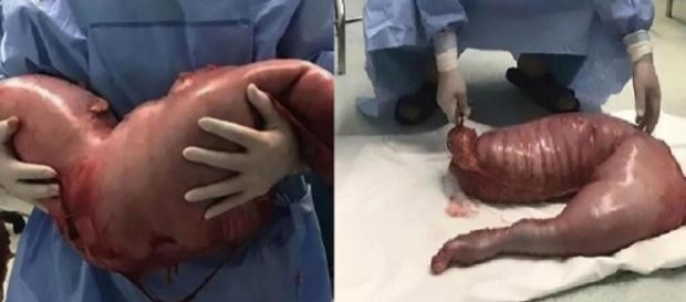 "Pensei que poderia explodir a qualquer momento", disse o médico que operou o chinês; rapaz foi diagnosticado com Doença de Hirschsprung "Pensei que poderia explodir a qualquer momento", disse o médico que operou o chinês; rapaz foi diagnosticado com Doença de Hirschsprung