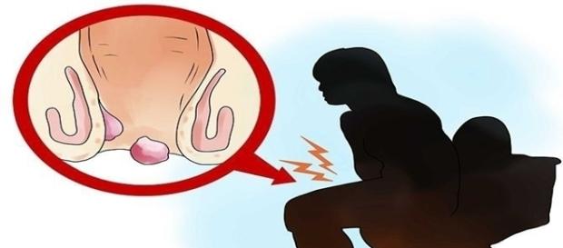 A taxa de cura do vaginismo é muito alta. (Foto reprodução/Wikihow) A taxa de cura do vaginismo é muito alta. (Foto reprodução/Wikihow)