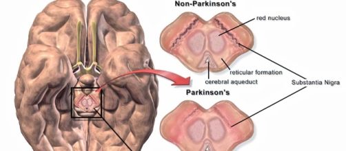 un orologio predice il Parkinson