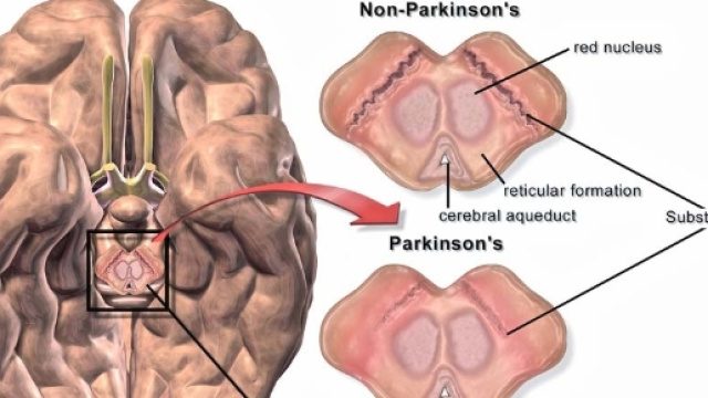 un orologio predice il Parkinson