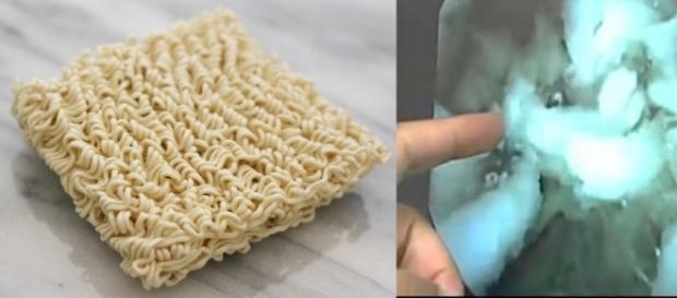 Veja o que acontece no seu estômago após você comer miojo ( Foto: Reprodução) Veja o que acontece no seu estômago após você comer miojo ( Foto: Reprodução)