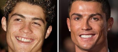 Cristiano Ronaldo, antes e depois do aparelho ortodôntico