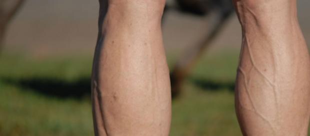 How To Get Rid Of Spider Veins Naturally? - stylecraze.com How To Get Rid Of Spider Veins Naturally? - stylecraze.com