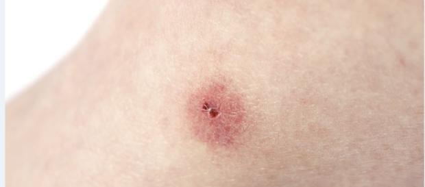 La enfermedad de Chagas - com.ni La enfermedad de Chagas - com.ni